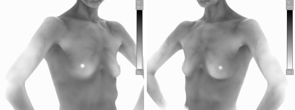 Nl-Breast-Oblique-View-Grey-Scale-1920w